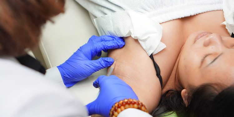 Atasi Ketiak Basah dan Bau karena Keringat Berlebih dengan Botox