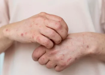 Waspada Campak: Kenali Gejala dan Cara Mencegahnya Sejak Dini