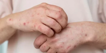 Waspada Campak: Kenali Gejala dan Cara Mencegahnya Sejak Dini