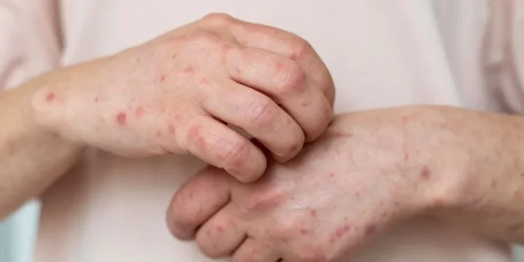 Waspada Campak: Kenali Gejala dan Cara Mencegahnya Sejak Dini